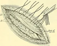 Picture 361 of 481 from Modern surgery, general and operative / by John Chalmers Da Costa. (1907), leaf 1010