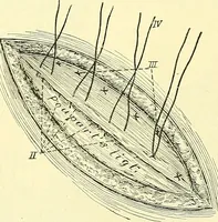 Picture 362 of 481 from Modern surgery, general and operative / by John Chalmers Da Costa. (1907), leaf 1010