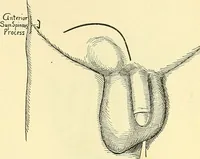 Picture 363 of 481 from Modern surgery, general and operative / by John Chalmers Da Costa. (1907), leaf 1011