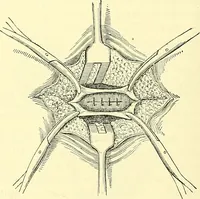Picture 364 of 481 from Modern surgery, general and operative / by John Chalmers Da Costa. (1907), leaf 1014