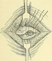 Picture 365 of 481 from Modern surgery, general and operative / by John Chalmers Da Costa. (1907), leaf 1015