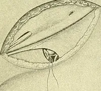 An illustration from Modern surgery, general and operative / by John Chalmers Da Costa. (1907)