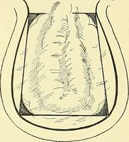Picture 367 of 481 from Modern surgery, general and operative / by John Chalmers Da Costa. (1907), leaf 1017