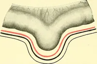 Picture 372 of 481 from Modern surgery, general and operative / by John Chalmers Da Costa. (1907), leaf 1028