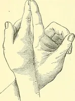 An illustration from Modern surgery, general and operative / by John Chalmers Da Costa. (1907)