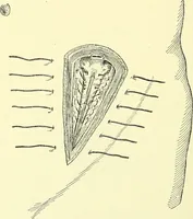 Picture 378 of 481 from Modern surgery, general and operative / by John Chalmers Da Costa. (1907), leaf 1044