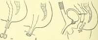An illustration from Modern surgery, general and operative / by John Chalmers Da Costa. (1907)