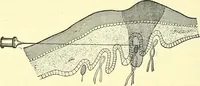 Picture 389 of 481 from Modern surgery, general and operative / by John Chalmers Da Costa. (1907), leaf 1076