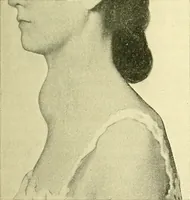 An illustration from Modern surgery, general and operative / by John Chalmers Da Costa. (1907)