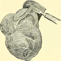Picture 393 of 481 from Modern surgery, general and operative / by John Chalmers Da Costa. (1907), leaf 1098