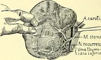 Picture 394 of 481 from Modern surgery, general and operative / by John Chalmers Da Costa. (1907), leaf 1098