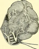 Picture 395 of 481 from Modern surgery, general and operative / by John Chalmers Da Costa. (1907), leaf 1098