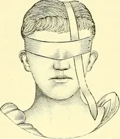 Picture 405 of 481 from Modern surgery, general and operative / by John Chalmers Da Costa. (1907), leaf 1110