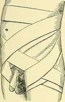 Picture 409 of 481 from Modern surgery, general and operative / by John Chalmers Da Costa. (1907), leaf 1111