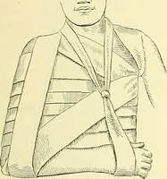 Picture 413 of 481 from Modern surgery, general and operative / by John Chalmers Da Costa. (1907), leaf 1113