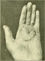 Picture 416 of 481 from Modern surgery, general and operative / by John Chalmers Da Costa. (1907), leaf 1116