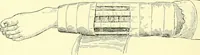 An illustration from Modern surgery, general and operative / by John Chalmers Da Costa. (1907)