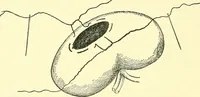 Picture 422 of 481 from Modern surgery, general and operative / by John Chalmers Da Costa. (1907), leaf 1134