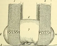 Picture 424 of 481 from Modern surgery, general and operative / by John Chalmers Da Costa. (1907), leaf 1147