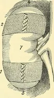 An illustration from Modern surgery, general and operative / by John Chalmers Da Costa. (1907)