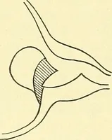 Picture 448 of 481 from Modern surgery, general and operative / by John Chalmers Da Costa. (1907), leaf 1219