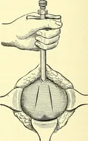 An illustration from Modern surgery, general and operative / by John Chalmers Da Costa. (1907)