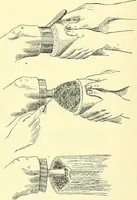 An illustration from Modern surgery, general and operative / by John Chalmers Da Costa. (1907)