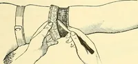 Picture 455 of 481 from Modern surgery, general and operative / by John Chalmers Da Costa. (1907), leaf 1233