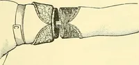 Picture 456 of 481 from Modern surgery, general and operative / by John Chalmers Da Costa. (1907), leaf 1233