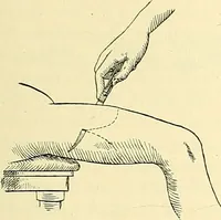 An illustration from Modern surgery, general and operative / by John Chalmers Da Costa. (1907)
