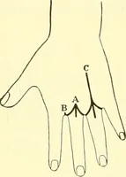 An illustration from Modern surgery, general and operative / by John Chalmers Da Costa. (1907)