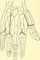Picture 460 of 481 from Modern surgery, general and operative / by John Chalmers Da Costa. (1907), leaf 1236