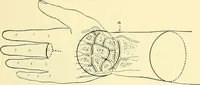 Picture 461 of 481 from Modern surgery, general and operative / by John Chalmers Da Costa. (1907), leaf 1237