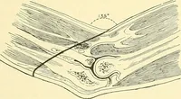 Picture 462 of 481 from Modern surgery, general and operative / by John Chalmers Da Costa. (1907), leaf 1237