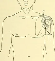 Picture 463 of 481 from Modern surgery, general and operative / by John Chalmers Da Costa. (1907), leaf 1239