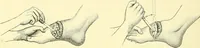 An illustration from Modern surgery, general and operative / by John Chalmers Da Costa. (1907)