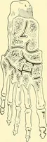 An illustration from Modern surgery, general and operative / by John Chalmers Da Costa. (1907)
