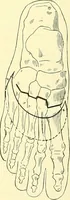 An illustration from Modern surgery, general and operative / by John Chalmers Da Costa. (1907)