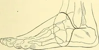 Picture 469 of 481 from Modern surgery, general and operative / by John Chalmers Da Costa. (1907), leaf 1243
