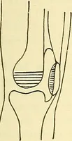 Picture 471 of 481 from Modern surgery, general and operative / by John Chalmers Da Costa. (1907), leaf 1247