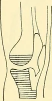 Picture 472 of 481 from Modern surgery, general and operative / by John Chalmers Da Costa. (1907), leaf 1247