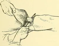 An illustration from Modern surgery, general and operative / by John Chalmers Da Costa. (1907)