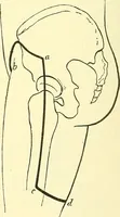 Picture 474 of 481 from Modern surgery, general and operative / by John Chalmers Da Costa. (1907), leaf 1248