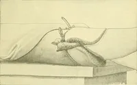 Picture 478 of 481 from Modern surgery, general and operative / by John Chalmers Da Costa. (1907), leaf 1251