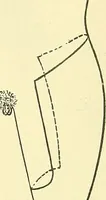 Picture 480 of 481 from Modern surgery, general and operative / by John Chalmers Da Costa. (1907), leaf 1253