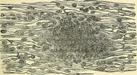 Picture 52 of 481 from Modern surgery, general and operative / by John Chalmers Da Costa. (1907), leaf 139