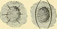 Picture 58 of 481 from Modern surgery, general and operative / by John Chalmers Da Costa. (1907), leaf 165