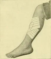 An illustration from Modern surgery, general and operative / by John Chalmers Da Costa. (1907)
