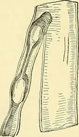 Picture 61 of 481 from Modern surgery, general and operative / by John Chalmers Da Costa. (1907), leaf 191