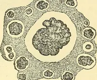Picture 4 of 481 from Modern surgery, general and operative / by John Chalmers Da Costa. (1907), leaf 25